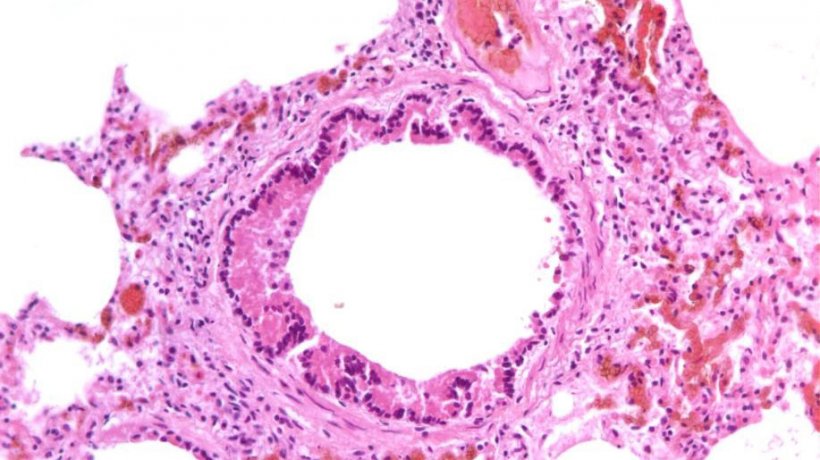 Figura 5: Bronchiolite necrotizzante causata da infezione da SIV.
