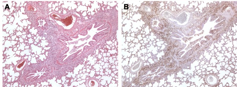 Figura 3. Polmone di suino co-infettato da M. hyopneumoniae e&nbsp;PCV2. A:&nbsp;Area di iperplasia&nbsp;linfoide peri-bronchiolare causata da M. hyopneumoniae. B: Gran quantit&agrave; di antigene da&nbsp;PCV2 nella stessa area di iperplasia linfoide.
