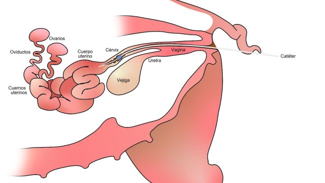 Immagine 1. Nell'inseminazione artificiale post-cerviale, il seme viene depositato nel corpo dell'utero, dopo la cervice.