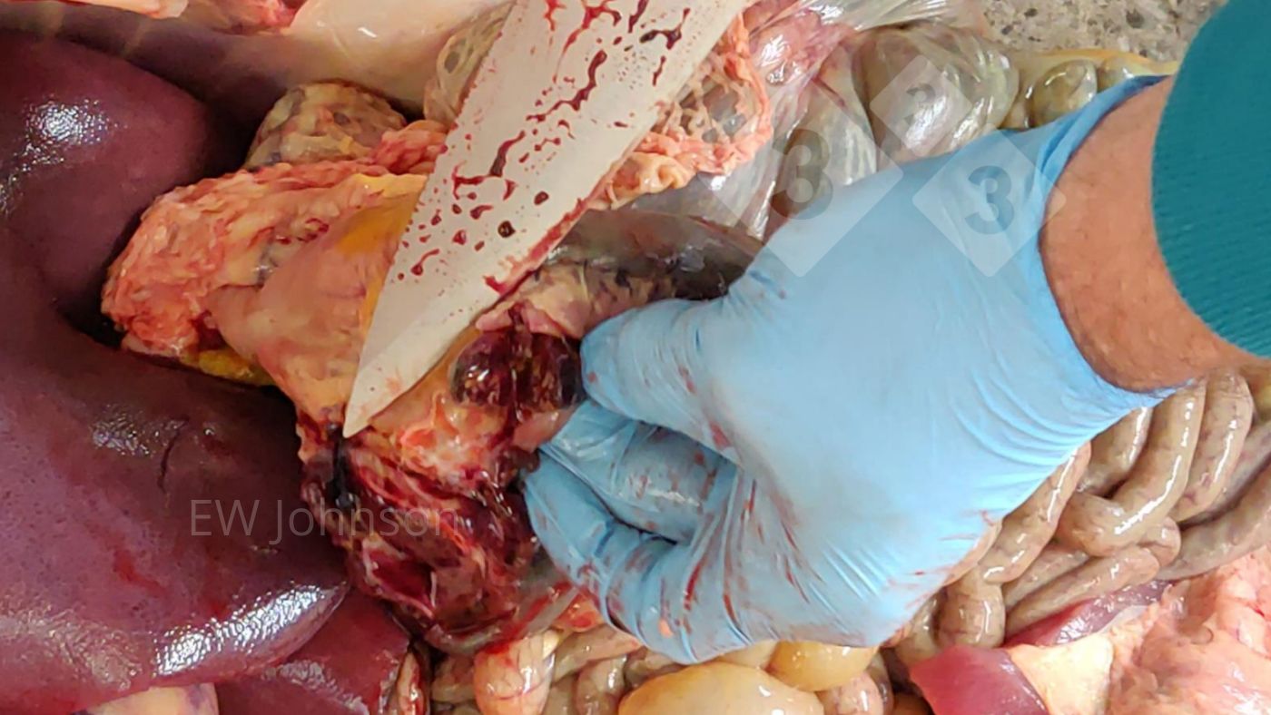 Foto 2. Emorragia e necrosi in un linfonodo gastroepatico.
