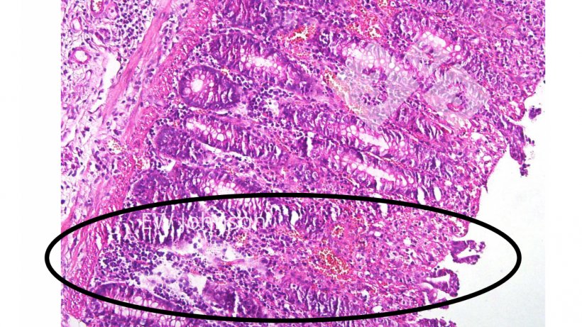 Foto 4. Trombosi vascolare, infarto, ulcerazione nella mucosa del colon.
