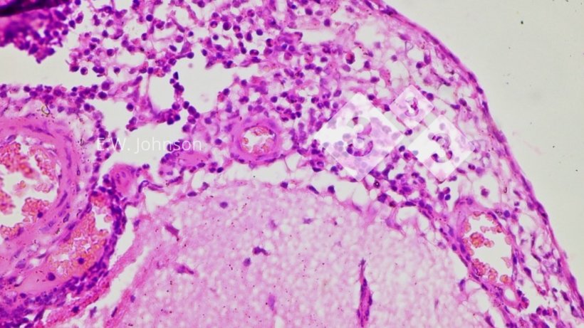 Immagine 3. Meningite con cellule mononucleate e alcune cellule polimorfonucleate. Cervello.
