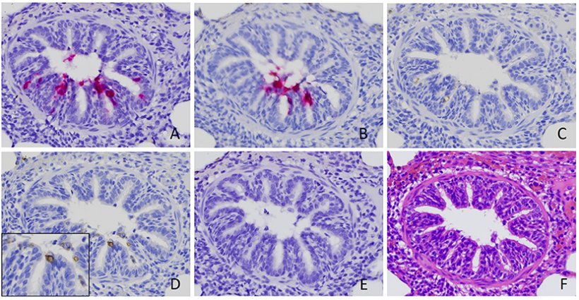 Figura 2. Identificazione di&nbsp;rotavirus A (RVA) nelle cellule epiteliali bronchiolari. Il segnale positivo dell&#39;acido nucleico RVA &egrave; stato rilevato mediante ibridazione in situ (ISH) utilizzando una sonda mirata a VP6 (A) e NSP3 (B). Segnali positivi di colorazione immunoistochimica utilizzando anticorpi contro RVA VP6 (C) e dsRNA (D), sebbene pi&ugrave; deboli, sono stati rilevati anche nelle sezioni seriali ottenute dallo stesso caso. Nessun segnale &egrave; stato rilevato da ISH utilizzando una sonda mirata al rotavirus B (E) (18). &Egrave; stata eseguita una sezione seriale con colorazione di routine con ematossilina ed eosina (F). Le immagini sono state scattate con un ingrandimento di 400x.
