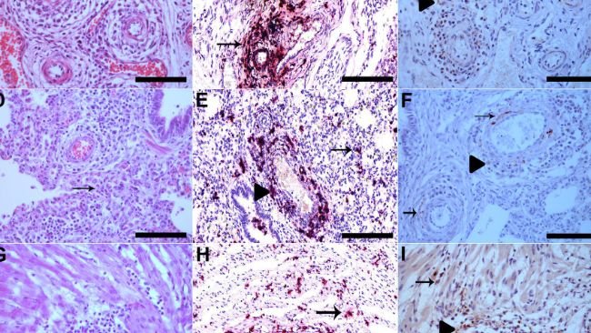 Figura 1. (A) Le pareti dei vasi del plesso mesenterico sono interrotte da una marcata infiltrazione di linfociti, istiociti e plasmacellule, oltre alla degenerazione fibrinoide (freccia), HE, Bar. 120 μm. (B) Plesso mesenterico vascolare con colorazione PCV3 nelle cellule infiammatorie e nelle pareti dei vasi che è mostrato in rosso (freccia), l'ematossilina è stata utilizzata come colorante di contrasto per tingere la sezione tissutale per ISH Bar. 120 μm. (C) Plesso mesenterico vascolare con immunomarcatura PCV3 nel citoplasma delle cellule infiammatorie nelle aree perivascolari (punta di freccia) e nel citoplasma e nel nucleo delle cellule della muscolatura liscia delle arterie (freccia), IHQ, AEC, Bar. 120 μm. (D) Polmone con setti alveolari diffusamente dilatati da linfociti e macrofagi (polmonite interstiziale) (freccia), HE, Bar. 120 μm. (E) Polmone con colorazione multifocale di PCV3 nelle cellule infiammatorie nelle aree interstiziali (freccia) e nelle aree perivascolari, che è mostrato in rosso (punta di freccia), ISH, Bar. 120 μm. (F) Polmone con immunomarcatura PCV3 nel citoplasma delle cellule infiammatorie nelle aree perivascolari (punta di freccia) e nel citoplasma e nel nucleo delle cellule della muscolatura liscia delle arterie (freccia), IHQ, AEC, Bar. 120 μm. (G) area di lieve miocardite linfoistiocitica (freccia), HE, Bar. 120 μm. (H) Cardiomiociti con colorazione PCV3 multifocale, mostrata in rosso (freccia), ISH, Bar. 120 μm. (I) Cuore con immunomarcatura PCV3 nel citoplasma delle cellule infiammatorie (punta di freccia) e nel citoplasma dei cardiomiociti (freccia), IHQ, AEC, Bar. 120 μm.
Ulteriori informazioni su questo testo di originePer avere ulteriori informazioni sulla traduzione è necessario il testo di origine
Invia commenti
Riquadri laterali