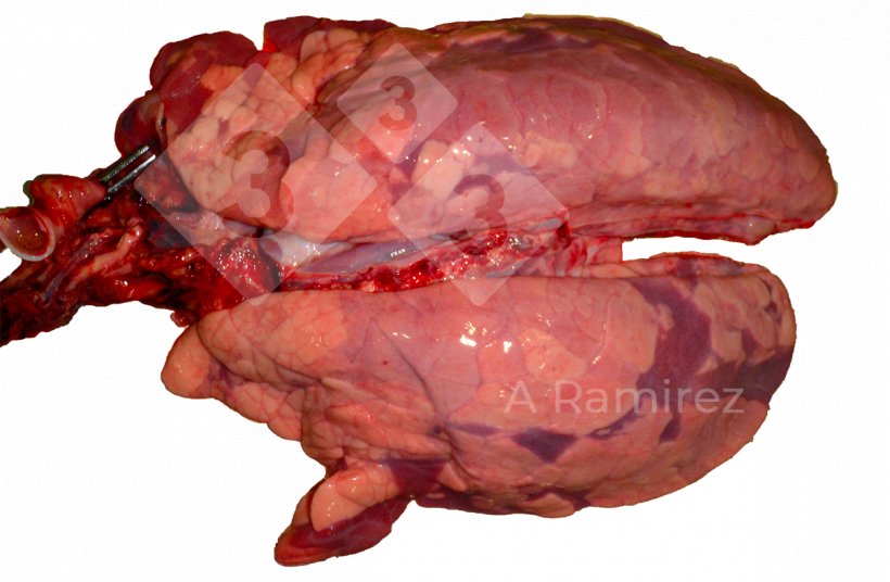 Figura 3: Infezione da influenza A con presentazione irregolare e diffusa con lieve edema interlobulare.
