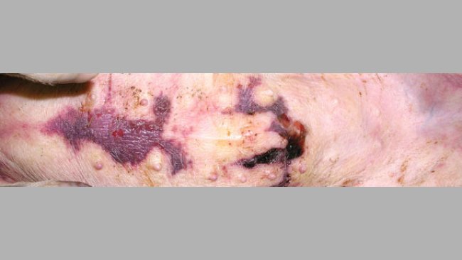 Accumulo di fluido sotto la pele in area esternale