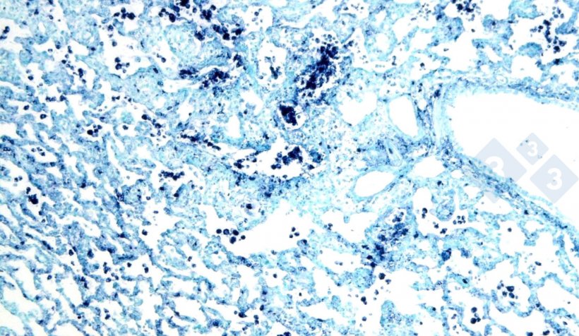 Figura 4. Ibridazione&nbsp;in situ per rilevare il circovirus suino 2 (PCV2) in un polmone affetto da polmonite interstiziale.
