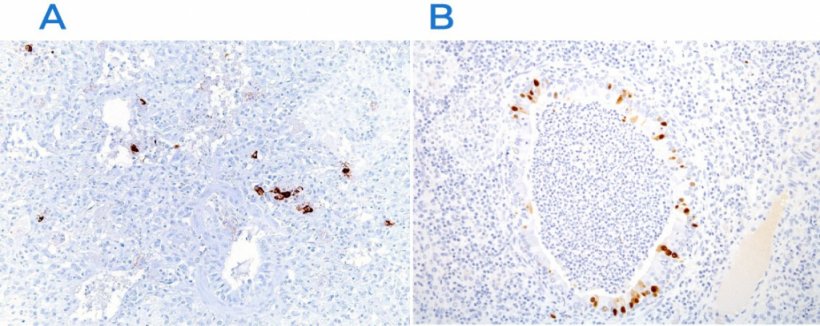 Figura 3. Immunoistochimica per rilevare il virus della sindrome riproduttiva e respiratoria suina (PRRSV) (A) e il virus dell&#39;influenza suina (B). Nelle aree colpite si riscontra la presenza dell&#39;antigene virale (colorazione marrone).
