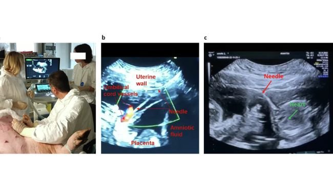 Innoculazione in utero dei feti della scrofa guidata dall'ecografia:a - Immagine rappresentativa dell'iniezione transaddominale. b - Immagine ecografica dell'iniezione di scAAV9-CAG-GFP nella vena ombelicale fetale. c - Immagine ecografica dell'iniezione intracardiaca di scAAV9-CAG-GFP.https://doi.org/10.1038/s41434-025-00551-8