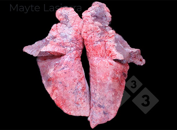 Processo con bronco-polmonite
