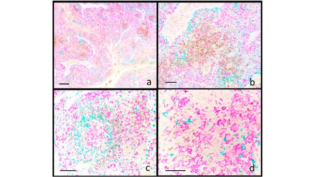 Suino. Linfonodo inguinale. Infezione sistemica da PCV2. Immunoistochimica multiplex per CD3 (marrone), CD20 (blu) e IBA1 (fucsia). (a) I follicoli radi e sbiaditi mostrano una riduzione dei linfociti CD20+ (b) e la presenza di cellule epitelioidi follicolari IBA1+ (c). Nell'area interfollicolare, i linfociti CD3+ sono fortemente ridotti (b, c), mentre i macrofagi IBA1+ sono aumentati (b). La colorazione per IBA1 è rilevabile anche nelle cellule epitelioidi e giganti (d). Barra della scala: (a) 800 μm; (b) 200 μm; (c) 150 μm; (d) 100 μm.Animals 2025, 15, 1682. https://doi.org/10.3390/ani15121682