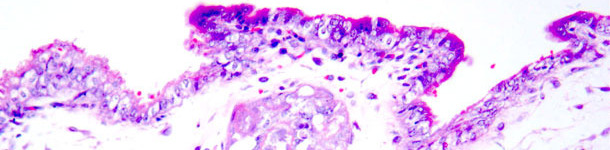 Necrosi coagulativa in trofoblasti. Ematossilina-Eosina. Tinci&oacute;n hematoxilina-eosina. 