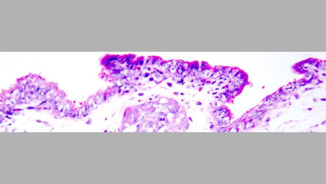 Necrosi coagulativa in trofoblasti. Ematossilina-Eosina. Tinción hematoxilina-eosina.