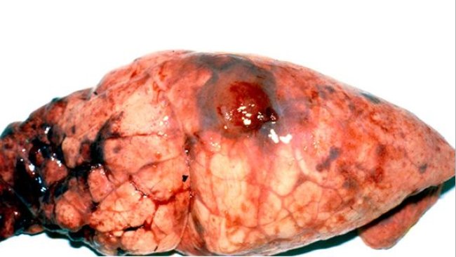 Lesioni di App sul lobulo diaframmatico con accumulo di fibrina.