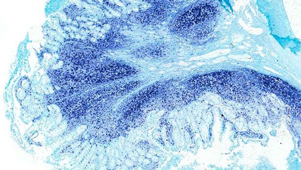 &Iacute;leon. El mismo &iacute;leon del cerdo afectado por enfermedad sist&eacute;mica asociada a PCV2 presenta una gran cantidad de genoma de PCV2 en las placas de Peyer y en la mucosa intestinal. Hibridaci&oacute;n in situ para detectar PCV2; colorante de contraste verde r&aacute;pido.