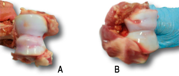 Osteocondrosi del condilo omerale.
