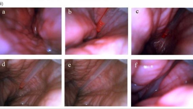 Inseminazione post-cervicale vista dall'inerno dell'utero