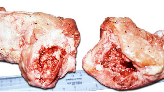 Cabeza del f&eacute;mur completamente fracturada por la ep&iacute;fisis o debajo de ella mostrando hinchaz&oacute;n alrededor de la fractura debido a periostitis