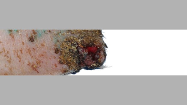 Ulcerazione, croste e spessimento dell'epiderme