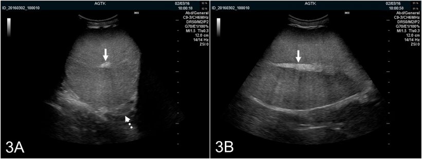 Figura 3:&nbsp;Immagini ecografiche del testicolo di un verro esplorato transversalmente (A) e&nbsp;longitudinalmente (B). Il rete testis si rappresenta come una macchia iperecogenica al centro del testicolo&nbsp;(freccia). Il parenchima testicolare presenta ecogenicit&agrave; media e tessitura omogenea. Anche l&#39;immagine trasversale offre una visualizzazione ottima del corpo dell&#39;epididimo(freccia punteggiata), che &egrave;&nbsp;normalmente similare ecogenicamente al testicolo.
