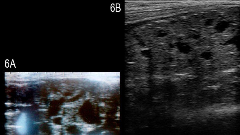 Figura 6: Immagini della ghiandola bulbouretrale del verro con cisti multiple anecogeniche ben definite di diverse misure&nbsp;(A) e quella di un verro sano&nbsp;(B) (Grahofer et al., 2016).
