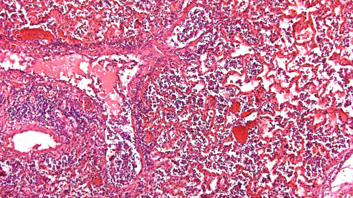 Alveoli con accumuli di liquidi e cellule infiammatorie