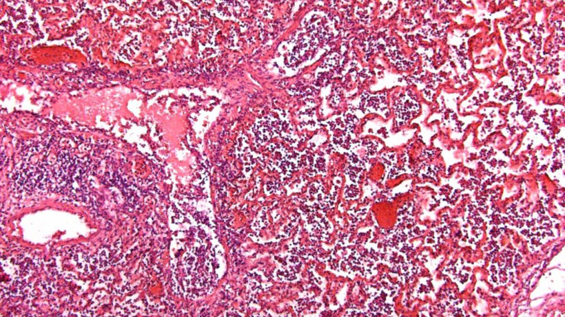 Figura 5. Alveoli con accumuli di liquidi e cellule infiammatorie.
