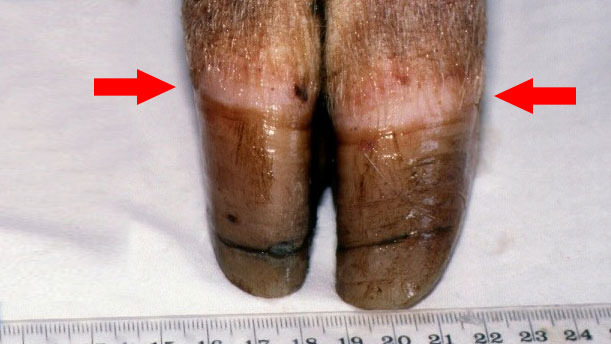 Figura 1. Banda coronaria- cercine coronario (freccia). Si noti la crescita irregolare e la fessura dell'unghiello.
