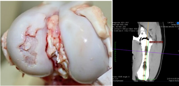 Visione macroscopica dell&#39;articolazione del ginocchio con una grave lesione da osteocondrosi nel condilo laterale del femore.
